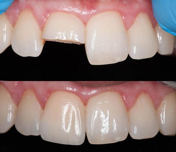 Dental Bonding in Siler City NC​