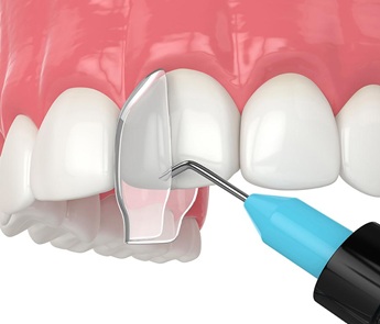 Close-up of a dental procedure: a blue-handled instrument works on the upper teeth with a cheek retractor in place.