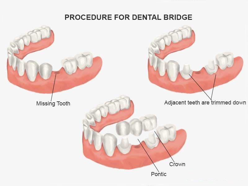 Dental Bridge Procedure - O2 Dental Group - O2 Dental Group Dental Bridge Procedure