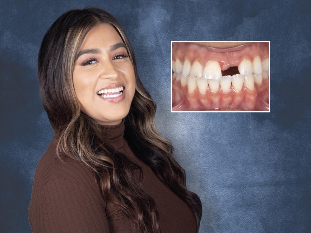 Dental Bridges in Wilmington - O2 Dental Group - O2 Dental Group Smiling woman with long wavy hair; inset shows a close-up of a front tooth gap in the teeth, suggesting dental treatment.