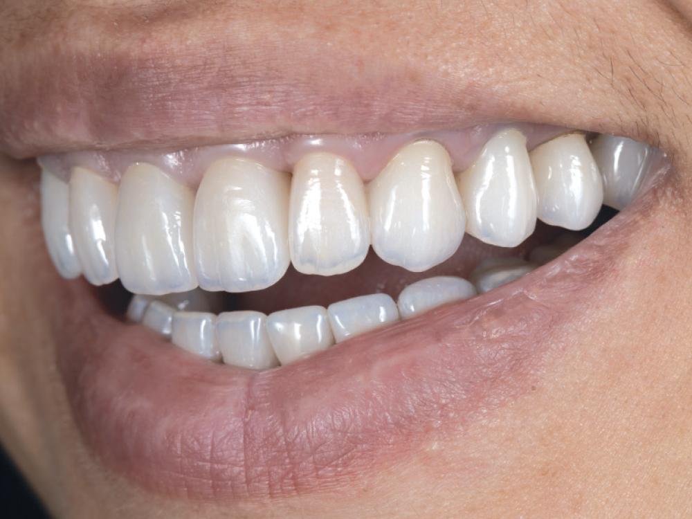 Dental Bridges Treatment - O2 Dental Group - O2 Dental Group Dental Bridges Treatment