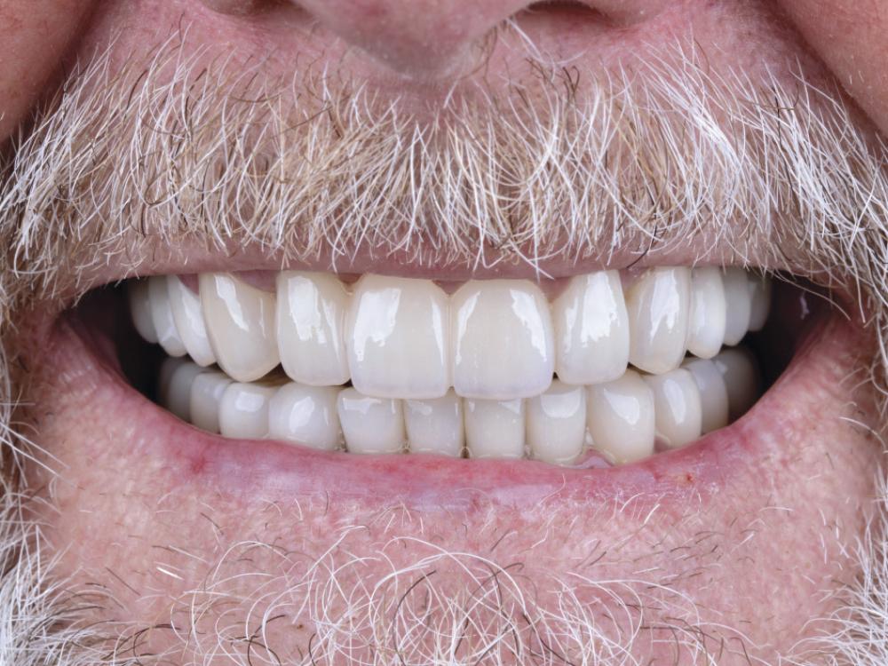 Dental Bridges Consultation - O2 Dental Group - O2 Dental Group Dental Bridges Consultation