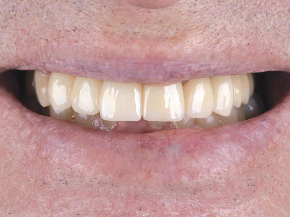 Dental Bridges - O2 Dental Group - O2 Dental Group Dental Bridges