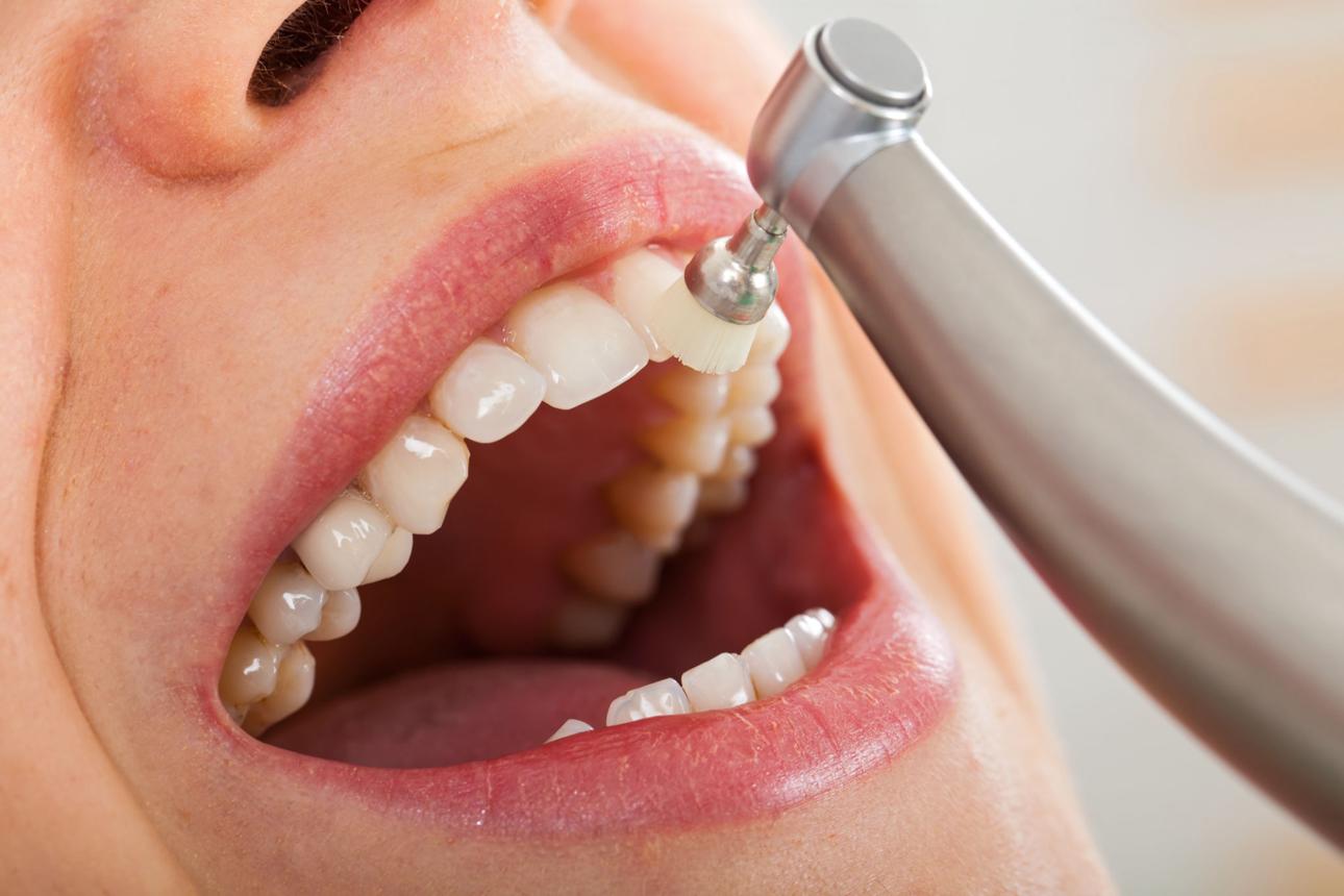 Dental Cleanings in Fayetteville