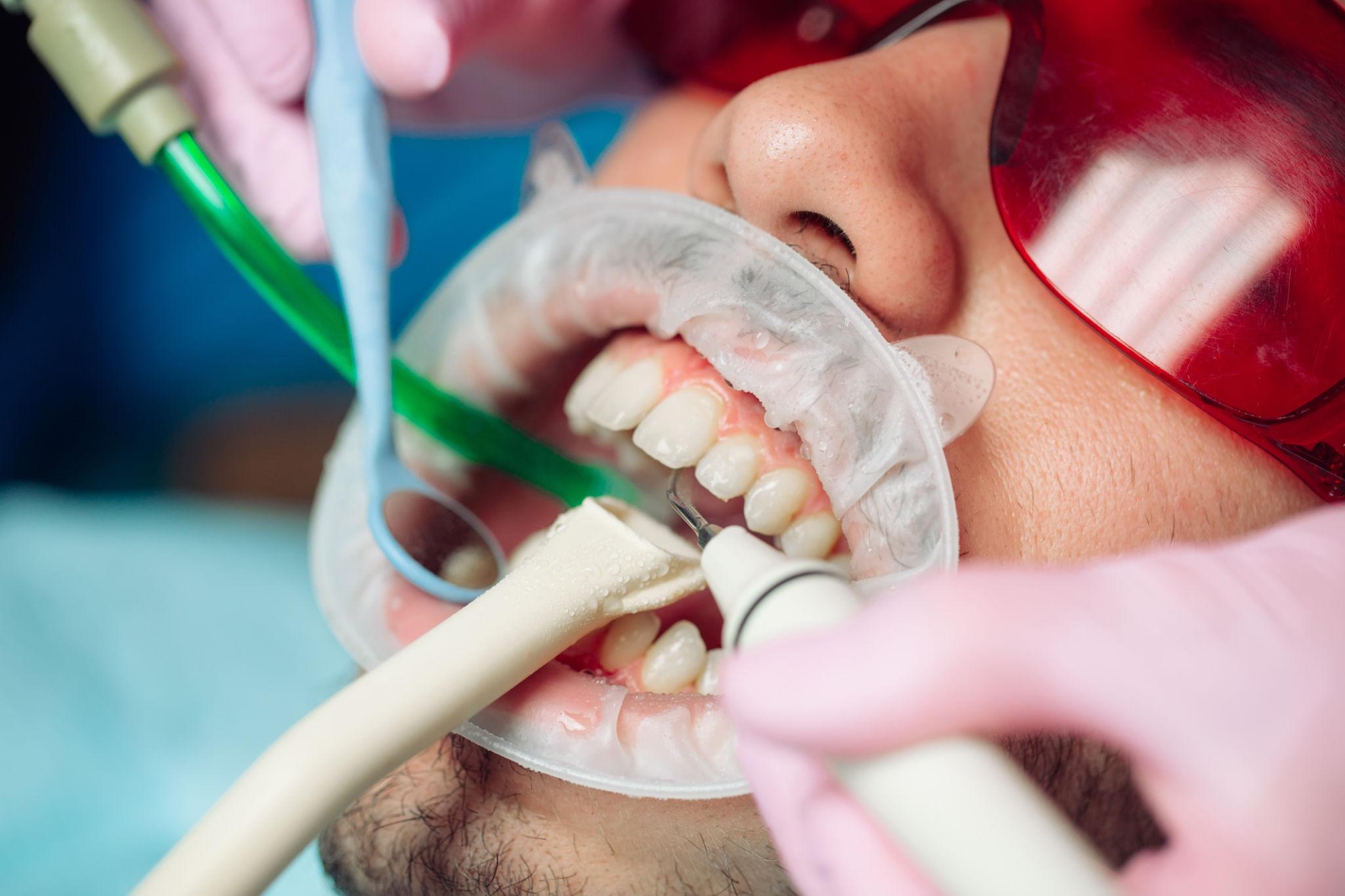 Dental Cleanings in North Carolina
