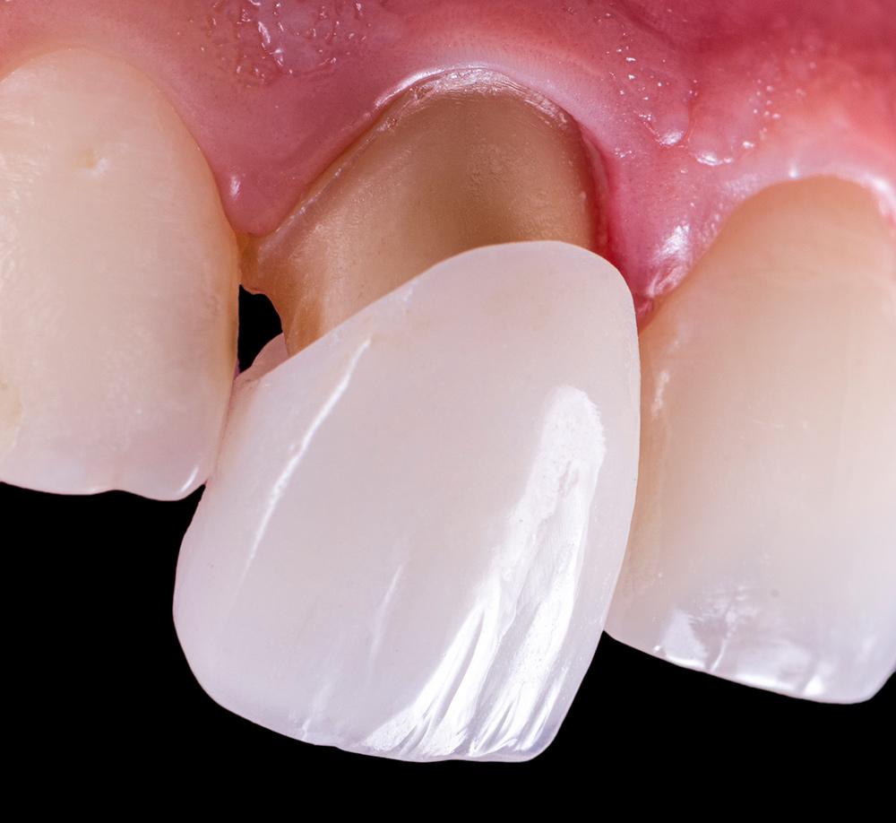 Dental Crowns in North Carolina