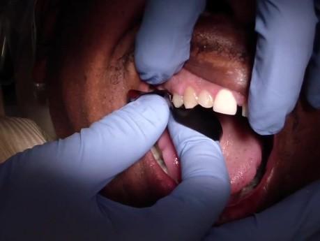 Dental Crowns in Siler City