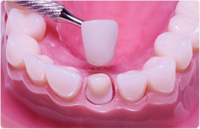 Dental Crowns in Wilmington