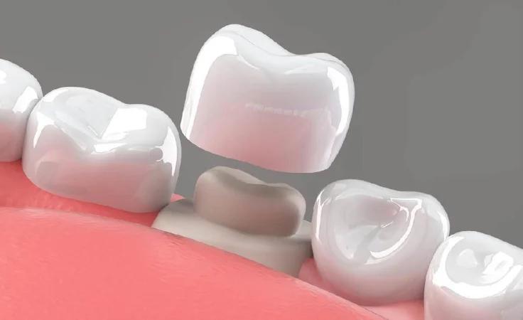 Dental Crowns