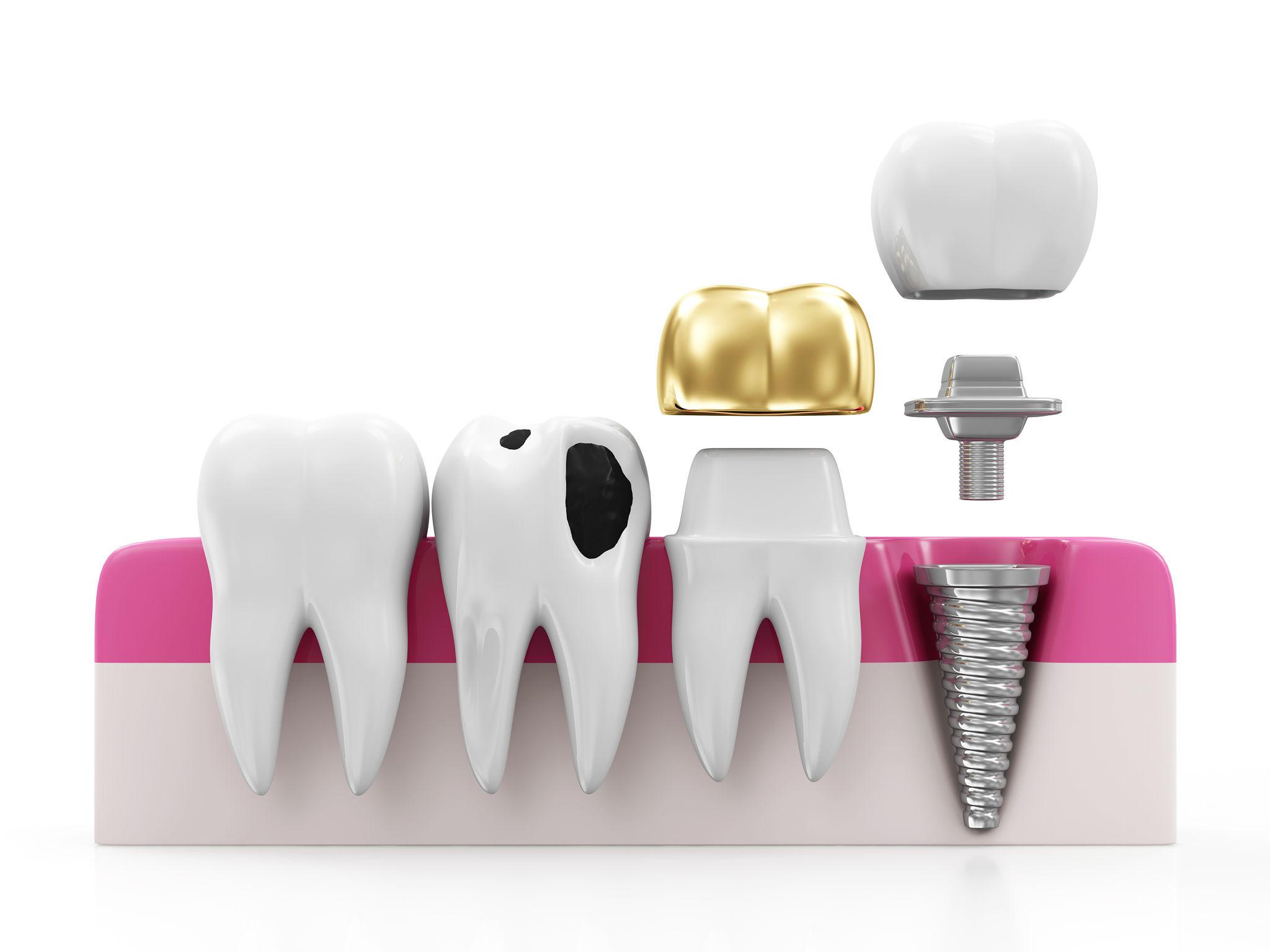 Same-Day Dental Crowns in Wilmington, NC​