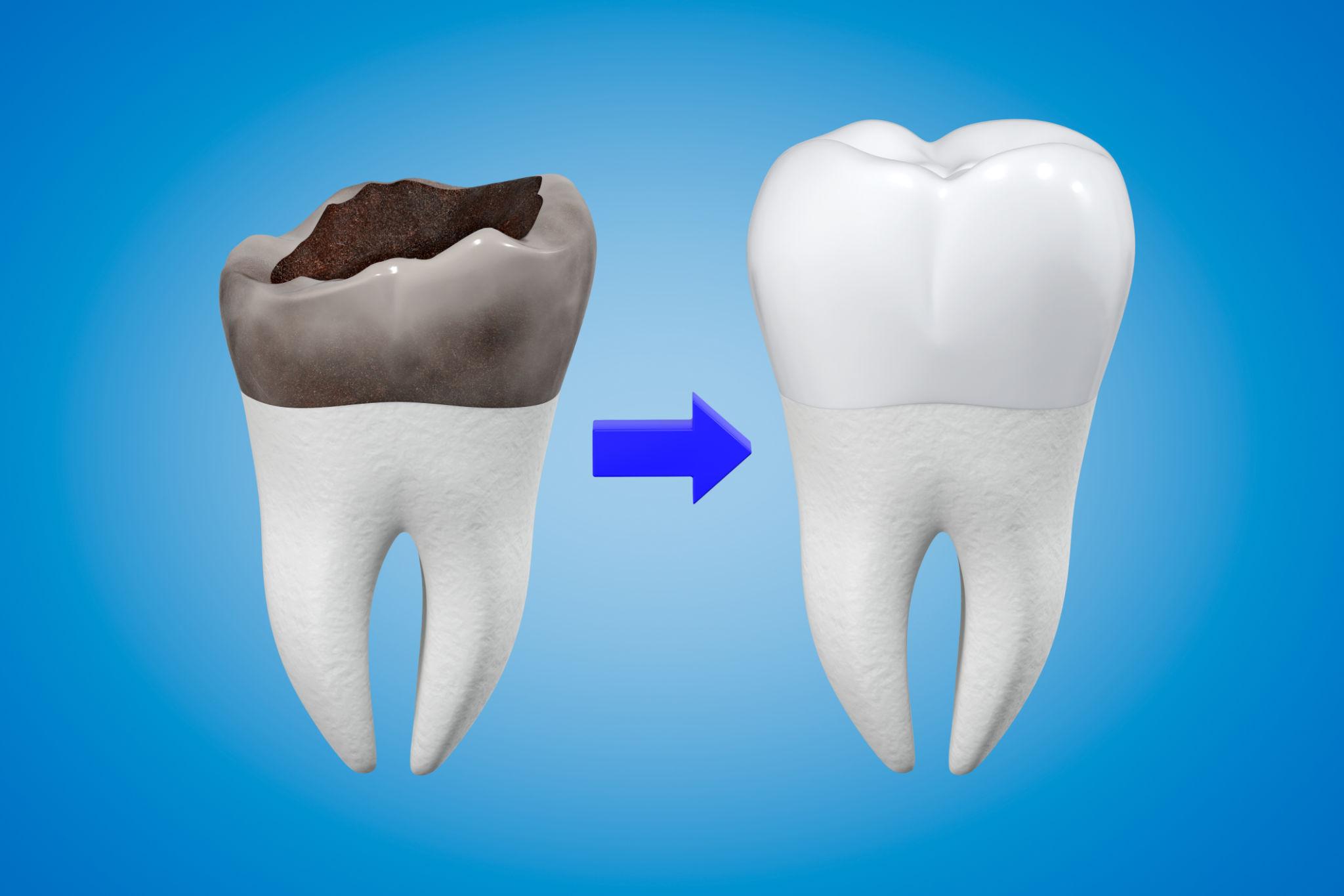 Dental Crowns