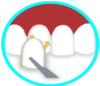 Dental procedure illustration: a wedge is placed between teeth as a dental tool works on a tooth near the gum.