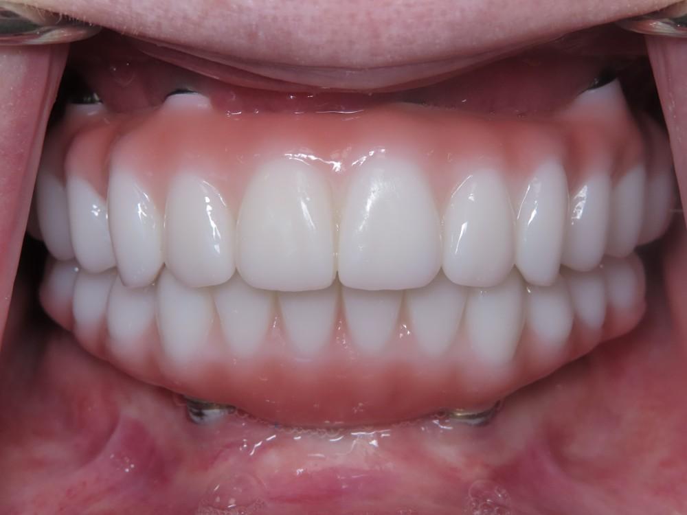 Custom Dentures in Wilmington, NC - O2 Dental Group - O2 Dental Group Custom Dentures in Wilmington, NC
