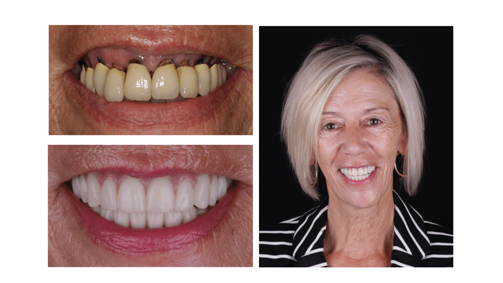 Dentures Consultation - O2 Dental Group - O2 Dental Group Dentures Consultation