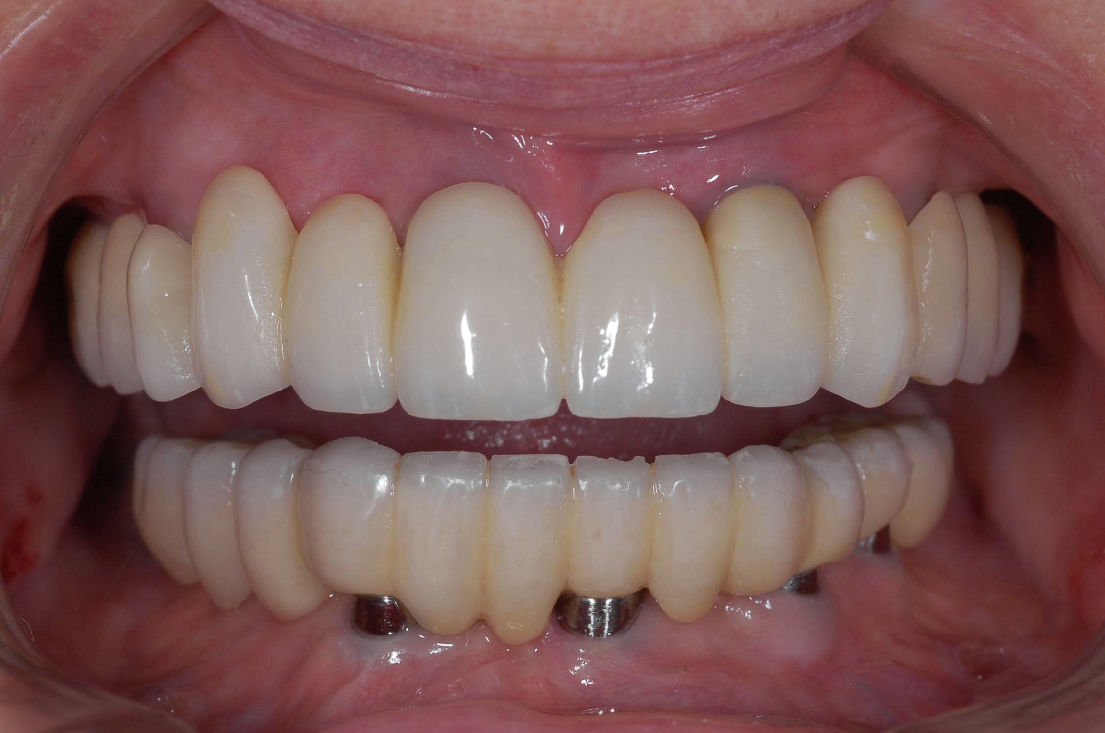 Full-Arch Implants - O2 Dental Group - O2 Dental Group Full-Arch Implants