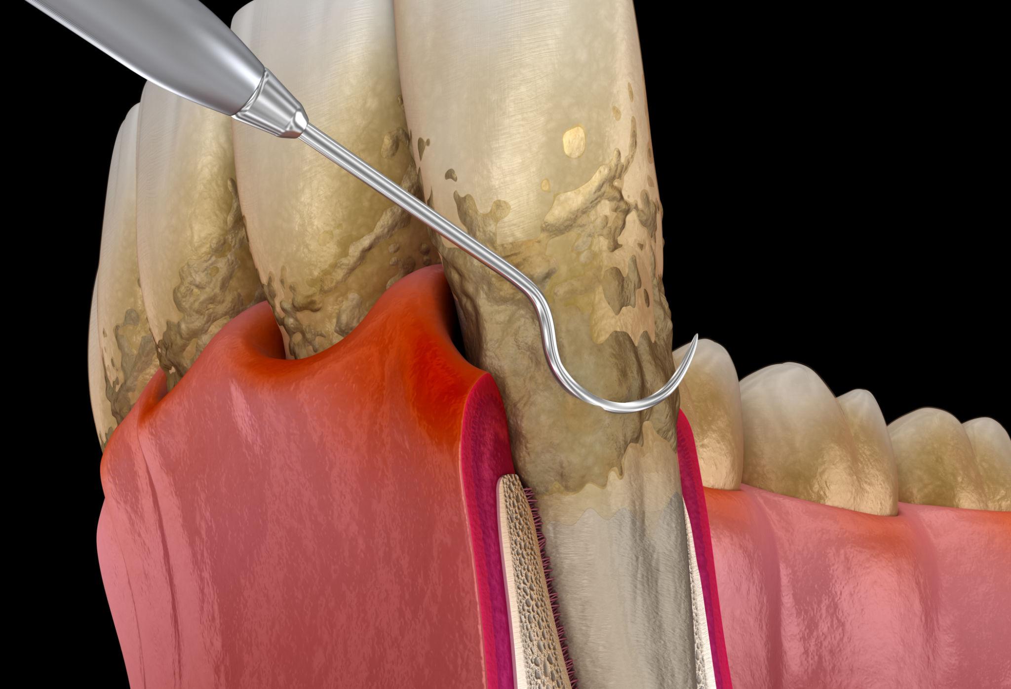 Gum Care and Treatment