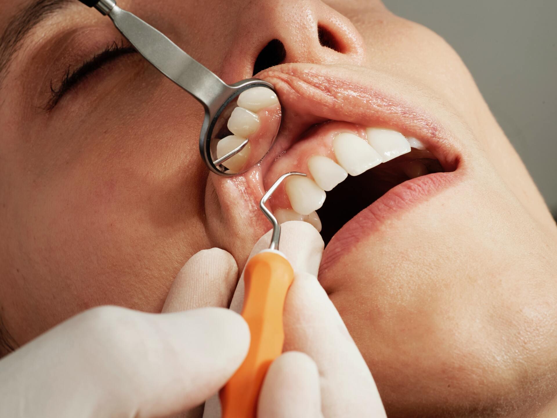 Gum Disease Treatment in Raleigh