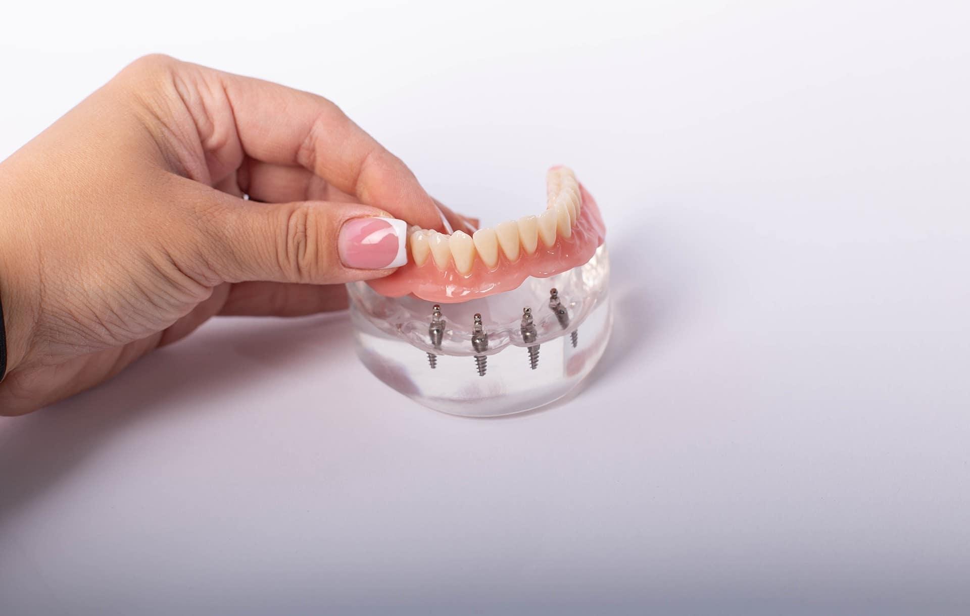 Person wearing a pink-nail manicure holds a lower denture with pink gums and metal implant screws visible underneath.