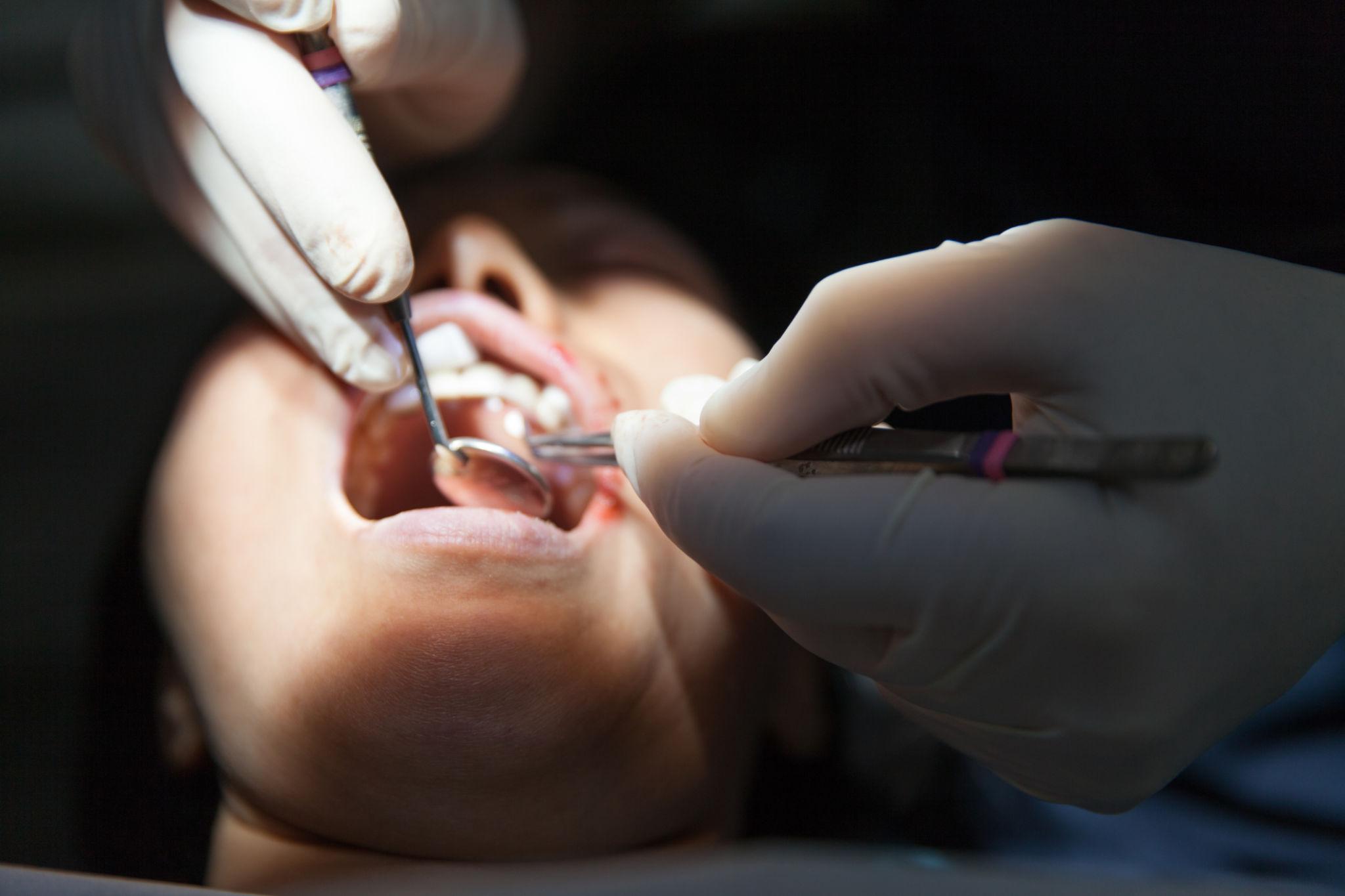 Close-up of a dentist's gloved hands working inside a patient's open mouth with dental tools during a procedure.