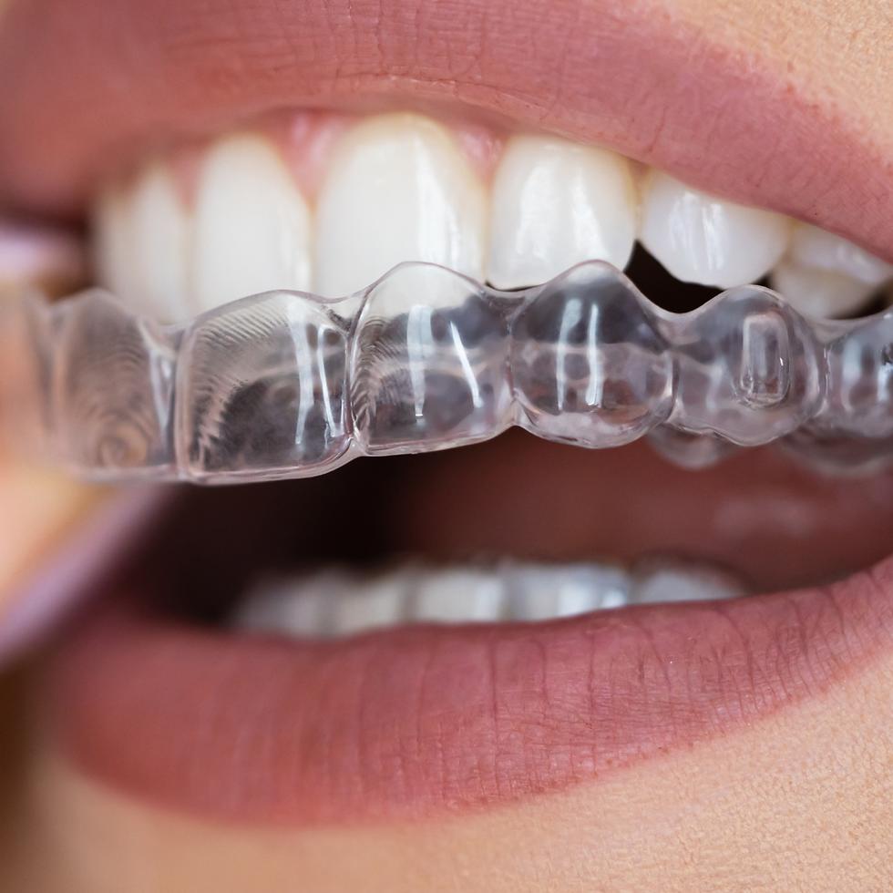 Invisalign and Clear Aligners