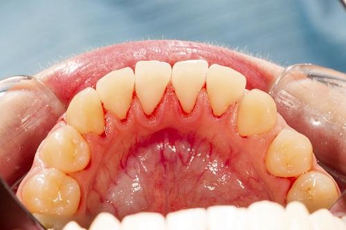 Periodontal Gum Disease Treatment