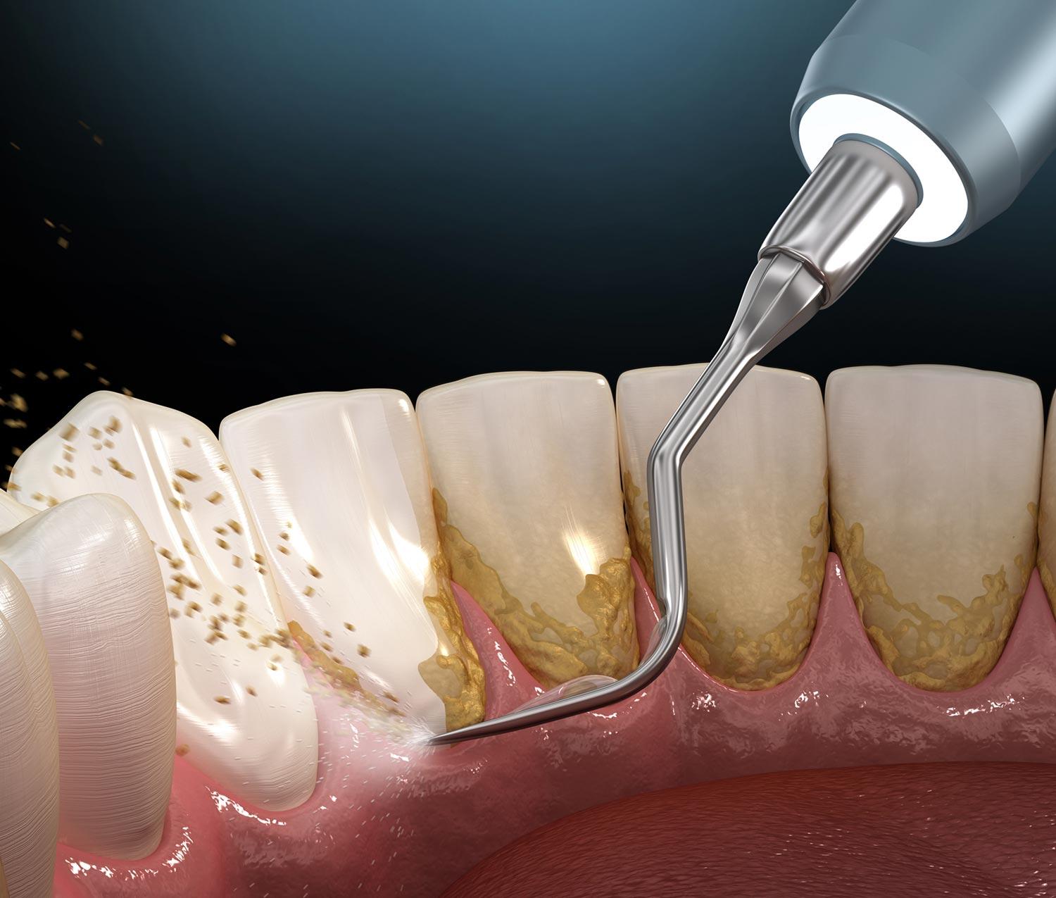 Gum Disease Treatment
