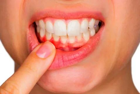 Periodontal Treatment