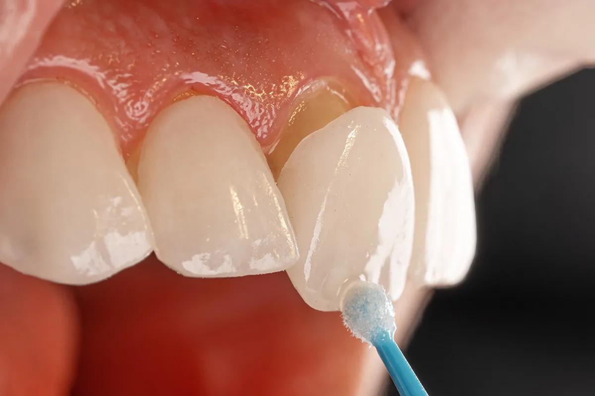 Porcelain Veneers Appointment Raleigh NC