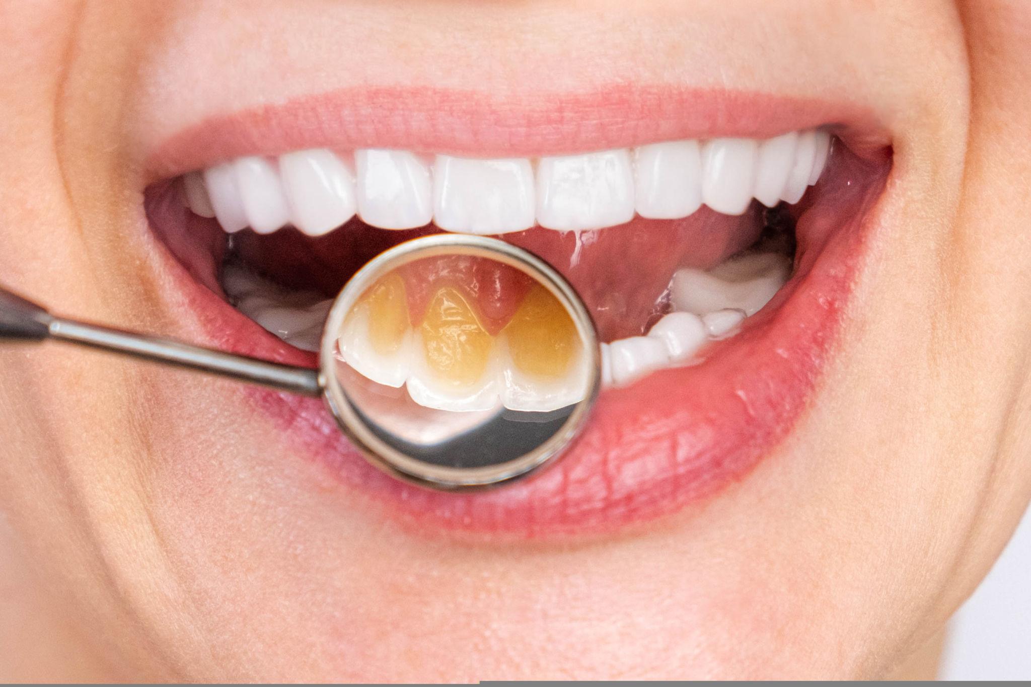 Dentist uses a mirror to inspect a patient’s open mouth, showing white teeth and upper gum line.