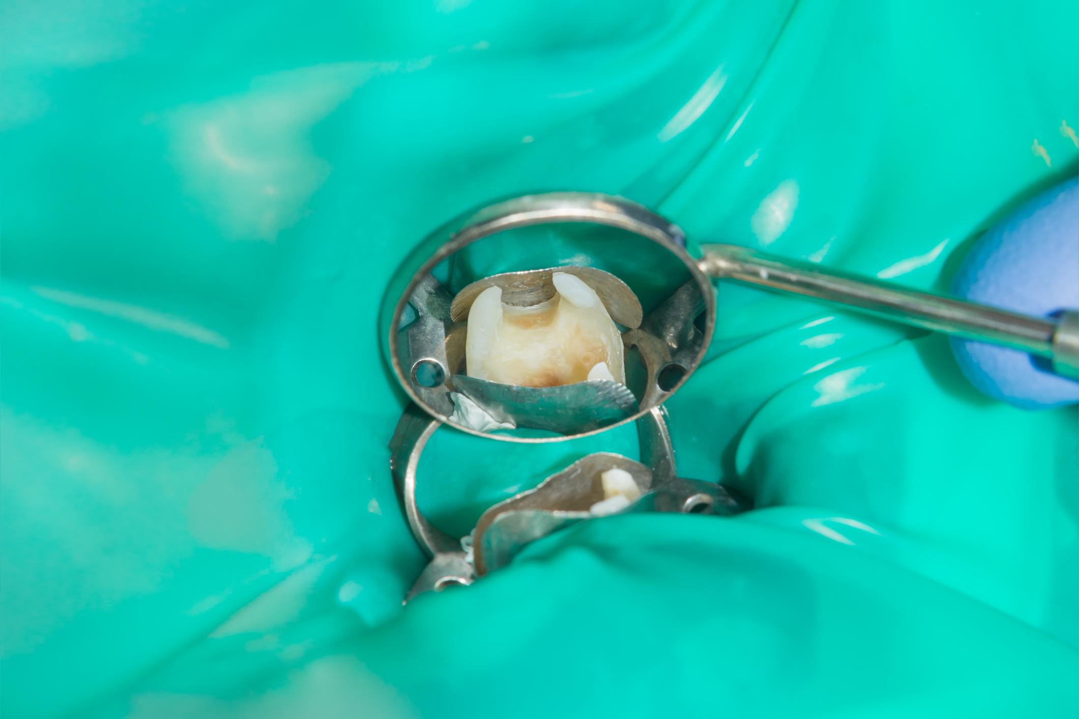 Root Canals