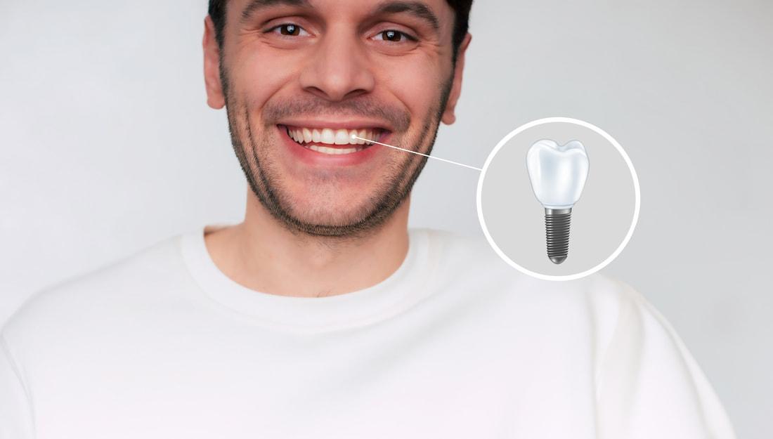 Same day dental implants Fayetteville
