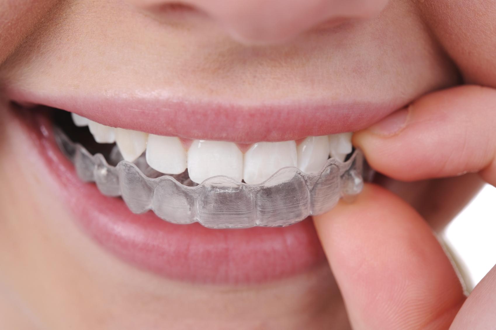 Close-up of a mouth with a clear aligner being placed over the upper teeth by someone’s fingers.