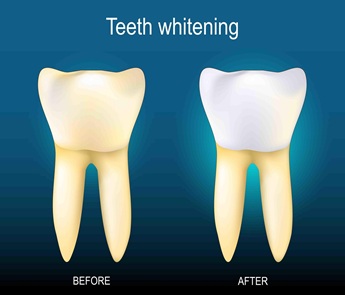 Teeth whitening before-and-after comparison showing a yellow left tooth and a whiter right tooth on a blue gradient background with BEFORE and AFTER labels.