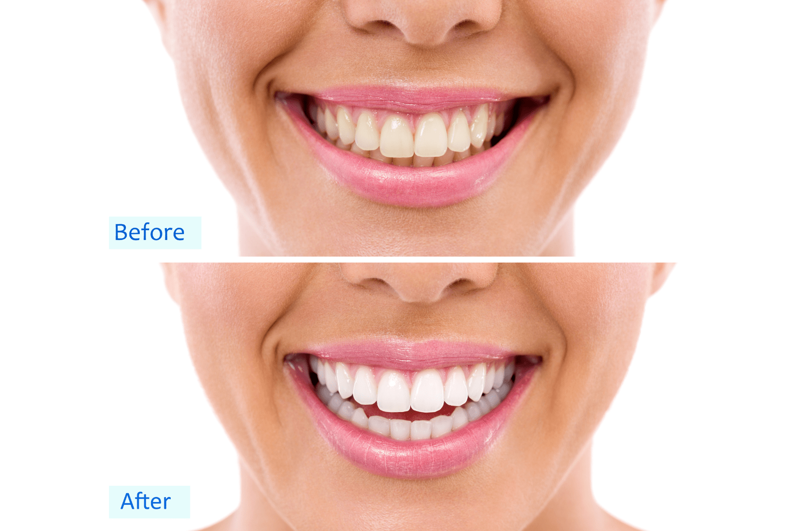 Teeth Whitening in North Carolina