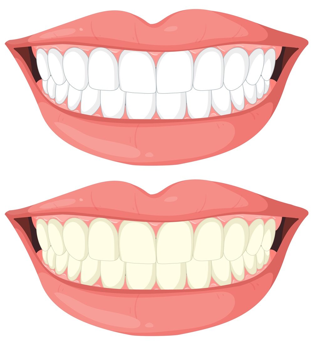 Teeth Whitening in Willington