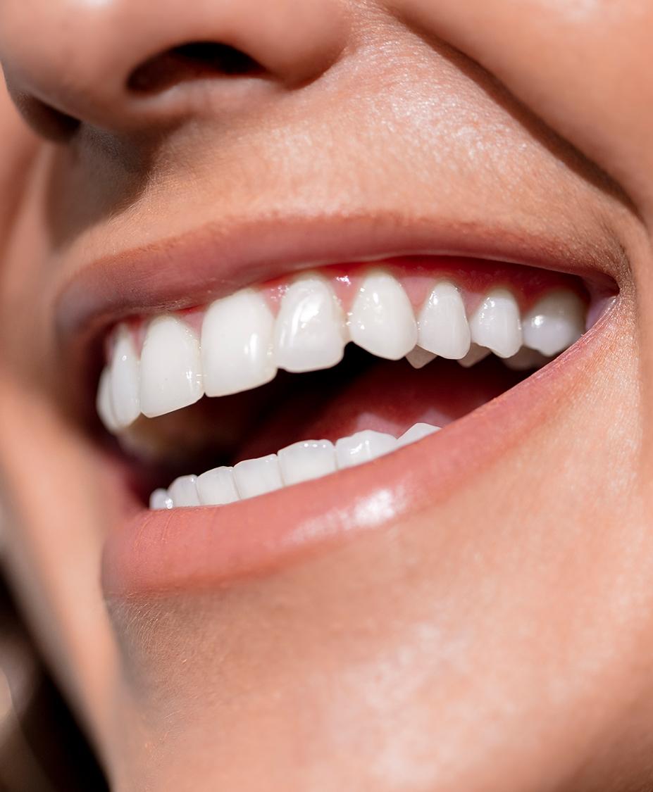 Teeth Whitening Treatment in Southern Pines NC