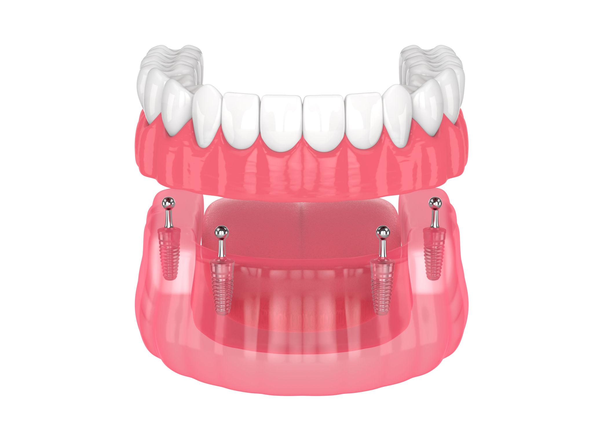 Dental implant model showing the upper jaw with multiple implants set in pink gum tissue.