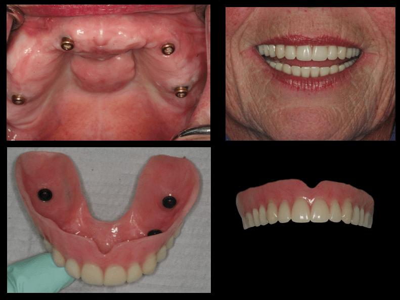 Collage of dental implant photos: upper jaw implants, a smiling woman with dentures, lower jaw model with implants, and a partial denture against a black background