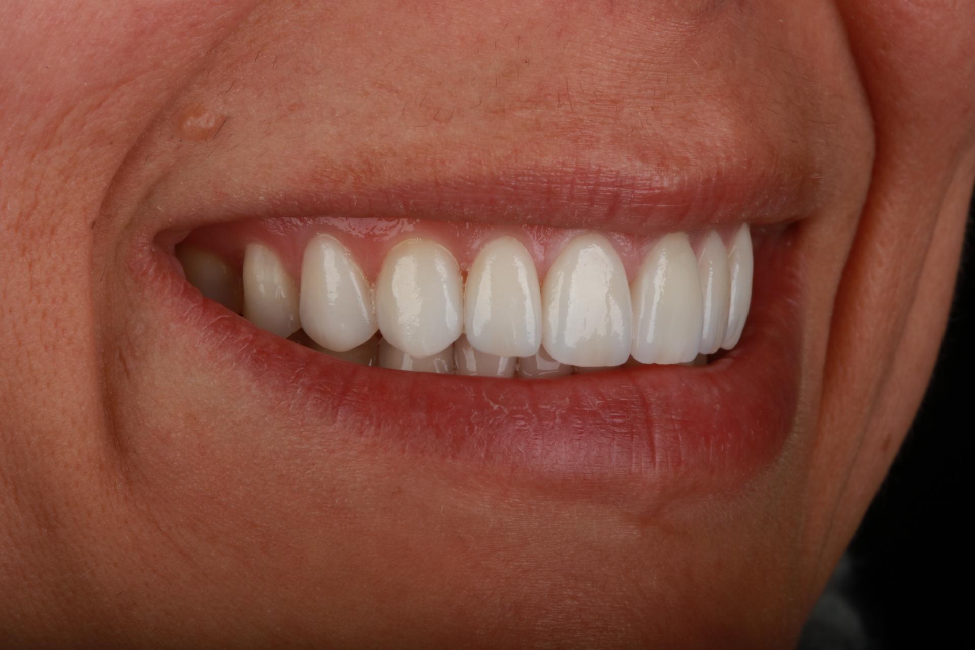 Close-up of a smile showing upper teeth with white veneers
