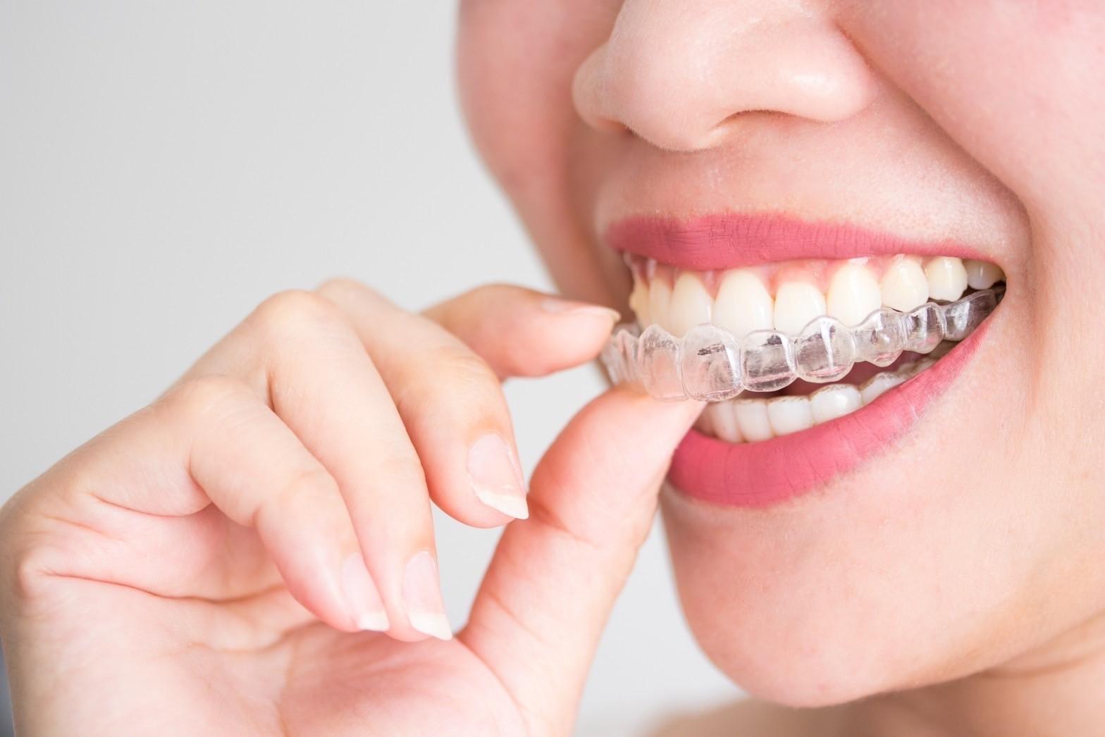 Close-up of a person inserting a clear dental aligner onto their teeth