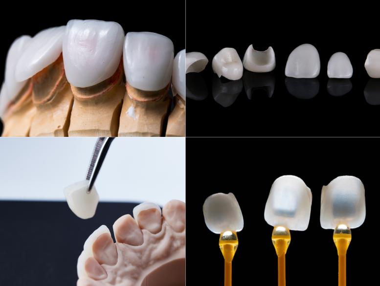 Collage of dental restoration workflow: tooth prep on a model, isolated teeth, a tooth held by forceps, and veneers with holders.