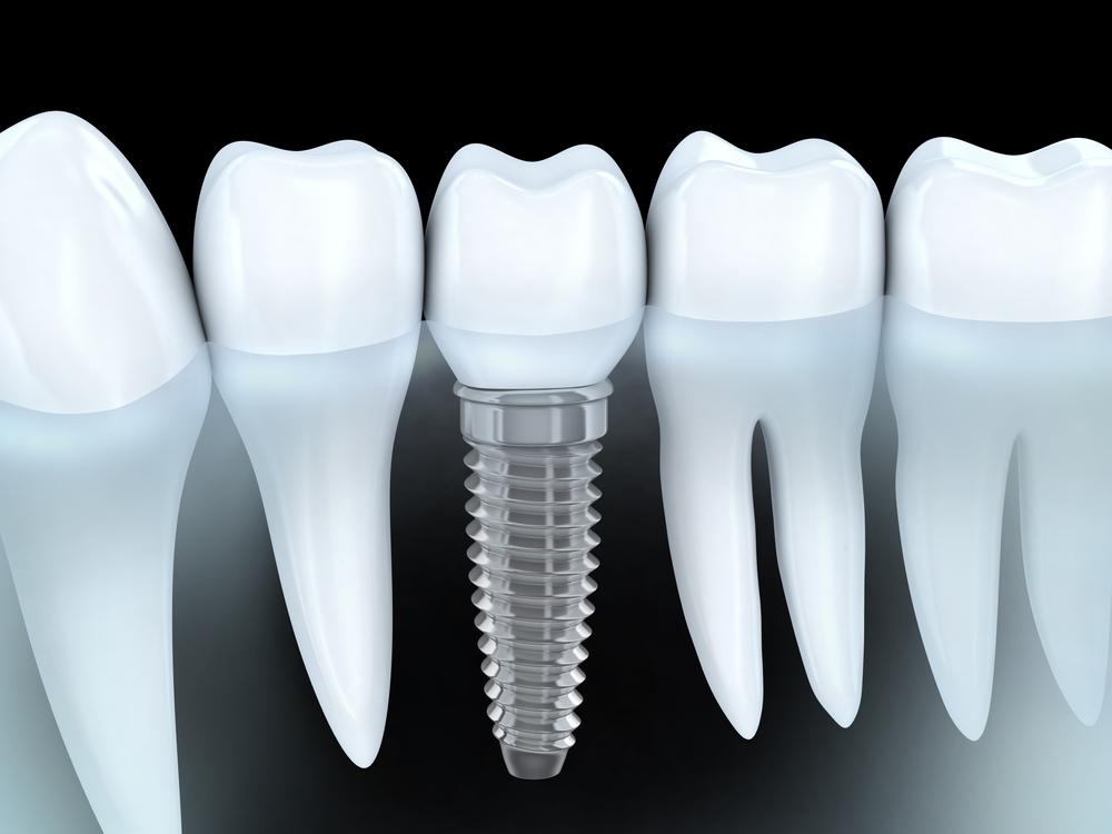 - O2 Dental Group - O2 Dental Group affordable dental implants Raleigh NC