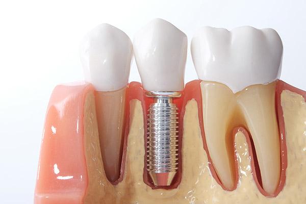 - O2 Dental Group - O2 Dental Group Dental implant model with a metal screw implant replacing a missing tooth between natural teeth.