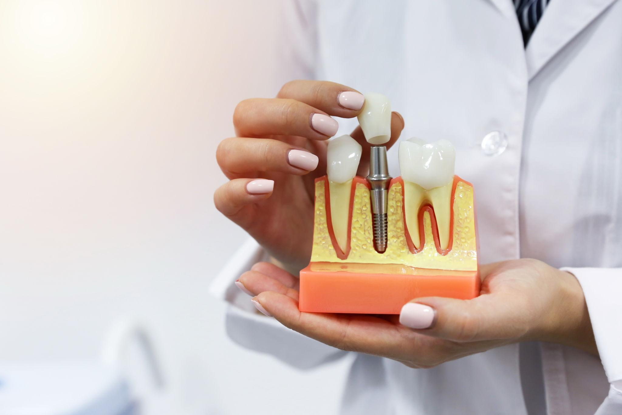 dental implants Wilmington NC