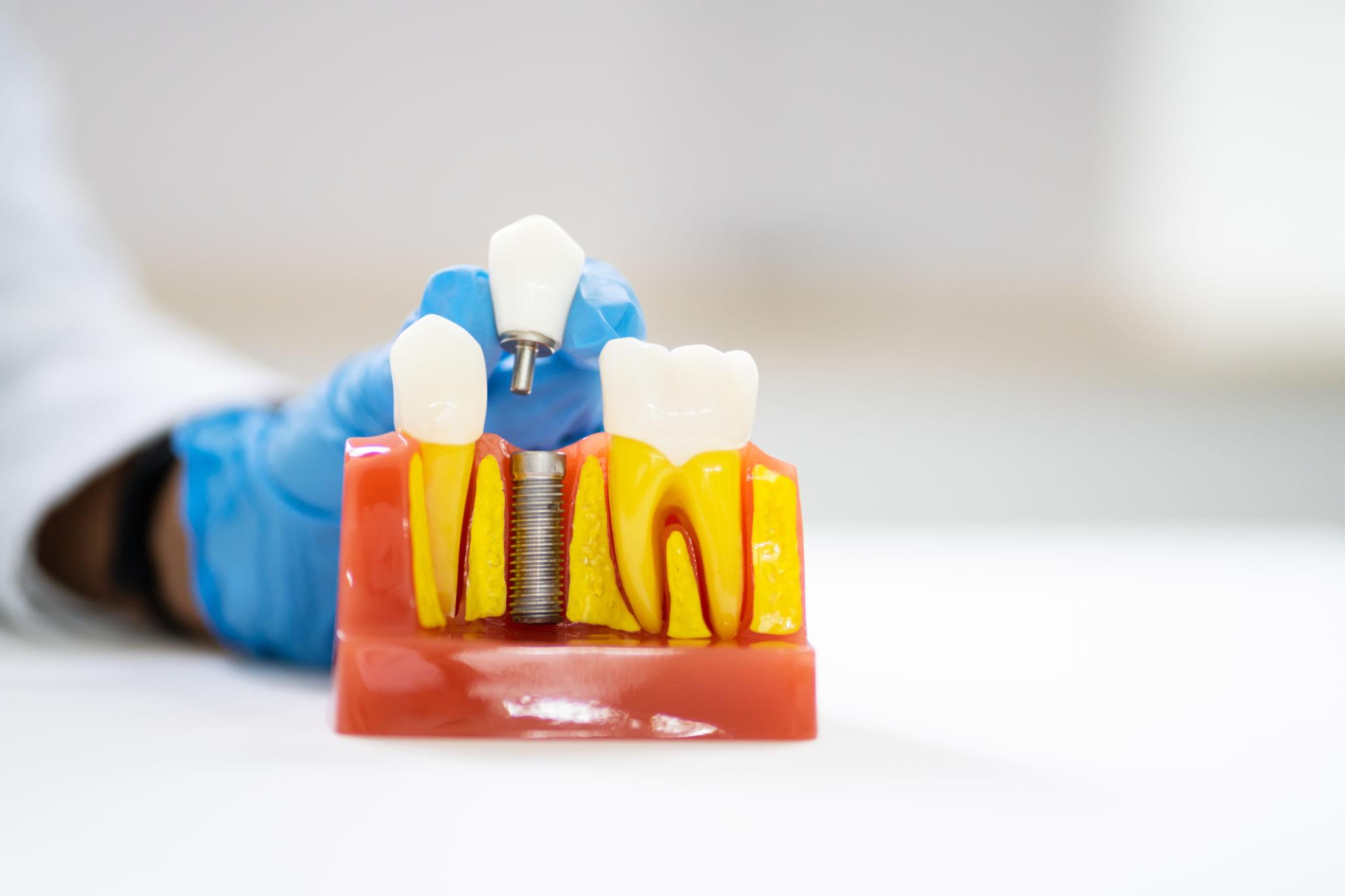 dental implants consultation Siler City NC - O2 Dental Group - O2 Dental Group dental implants consultation Siler City NC