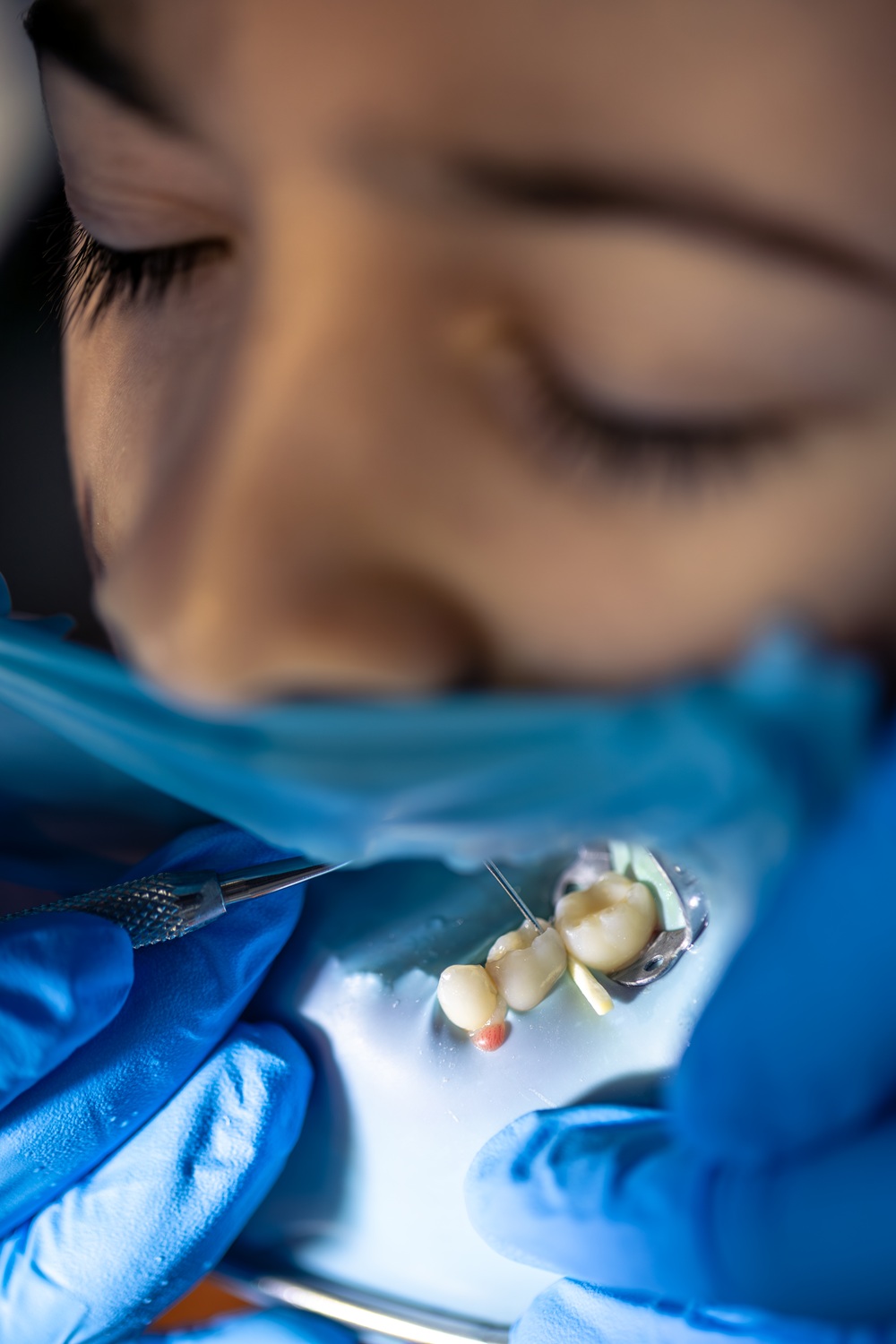 Tooth Extractions - O2 Dental Group - O2 Dental Group Tooth Extractions
