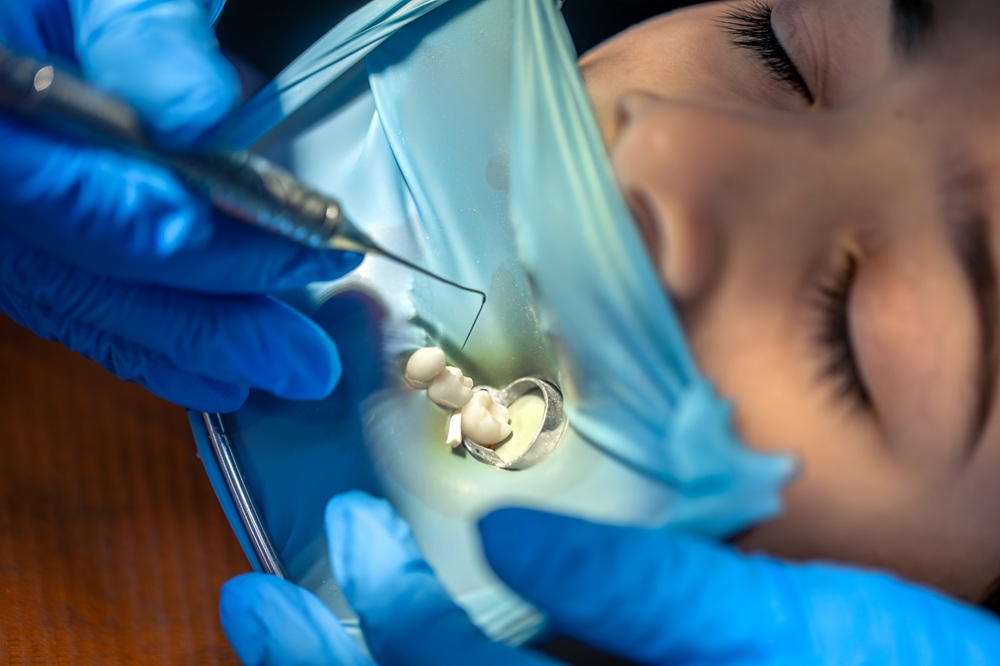 Root Canals