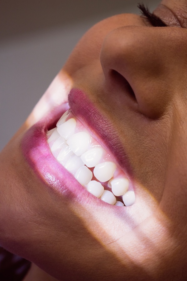 Teeth Whitening Consultation