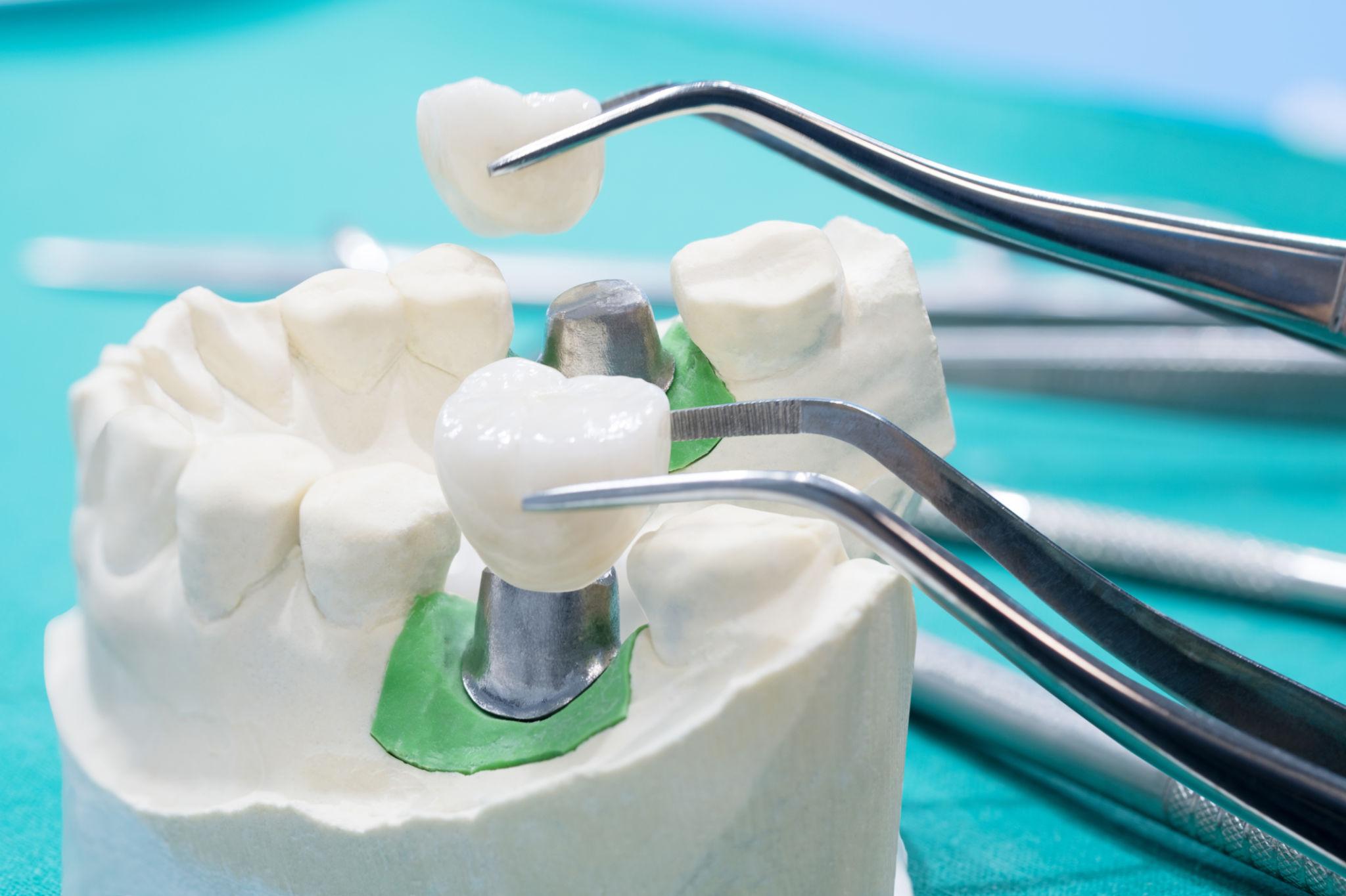 full mouth dental implants Wilmington NC