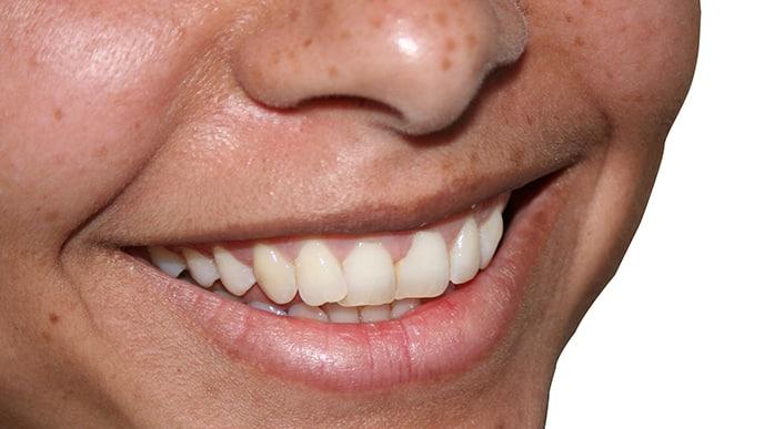 invisalign cleaning Wilmington NC - O2 Dental Group - O2 Dental Group invisalign cleaning Wilmington NC